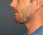 Feel Beautiful - Necklift and Chin Implant 203 - After Photo